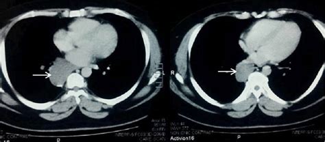 Axial View Of Chest Ct Showing Paravertebral Bronchogenic Cyst In The