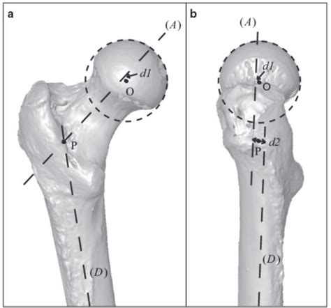 diagram demonstrating   position    axis   femoral