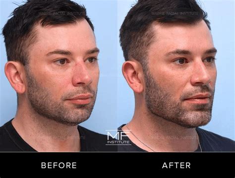 Jawline Filler For Men Transformative Before And After Photos Mabrie