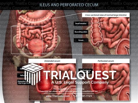 Ileus And Perforated Cecum TrialQuest Inc