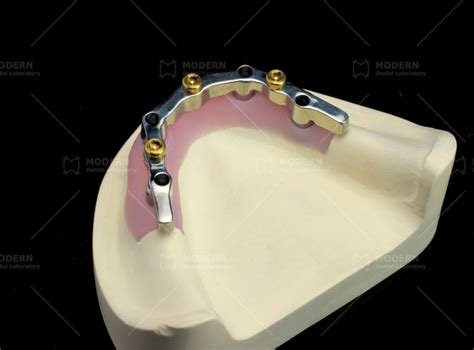 Digitek Implant Bar Bridge Modern Dental Lab