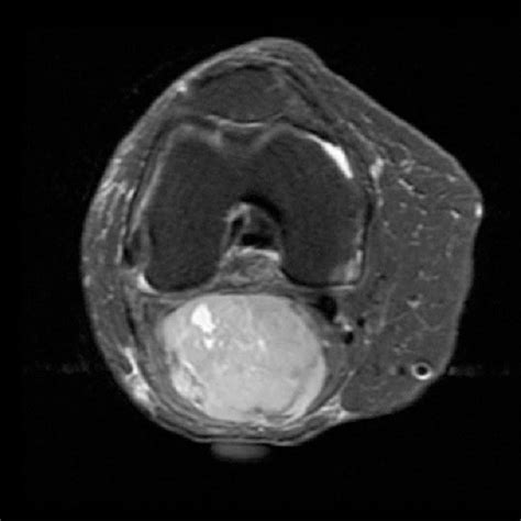 PDF Unusual Presentation Of Popliteal Soft Tissue Sarcoma Not Every