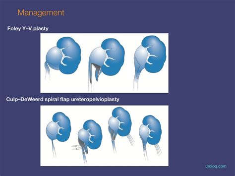 Ureteropelvic Junction Upj Obstruction