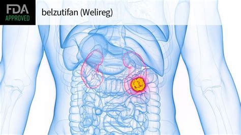 FDA Approves Merck's Belzutifan for Advanced Renal Cell Carcinoma Treatment