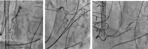 Coronary spasm was still partially present, but flow gradually improved ...