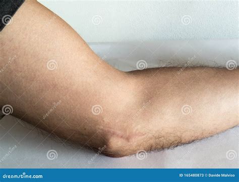 Scar On The Elbow Stock Image Image Of Elbow Scar 165480873