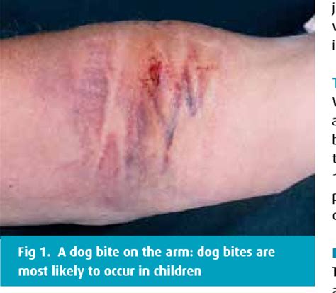 Figure 1 From The Management Of Animal And Human Bite Wounds