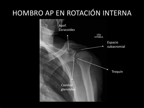 Radiografia Ap De Hombro