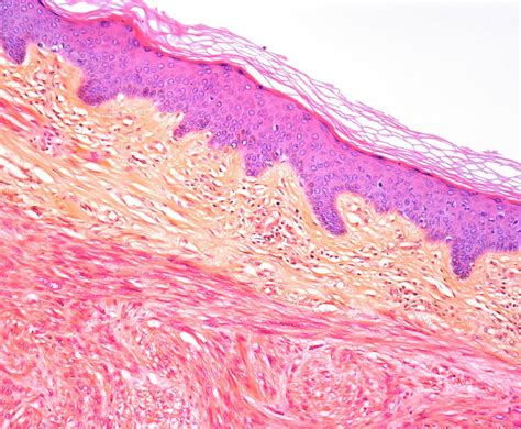 Leiomyosarcoma Of Skin Light Micrograph Photograph By Steve Gschmeissner