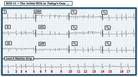 Ken Grauer, MD on Twitter: "This ECG was obtained from a patient with