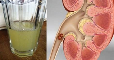 Fight Kidney Stones With This Refreshing Lemonade Recipe DailyHealthPost