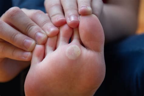 Foot Corns And Callus Causes Symptoms And Remedies