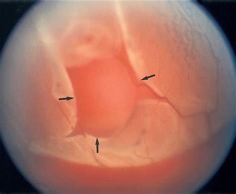 La Clinica Oculistica Virtuale Distacco Di Retina