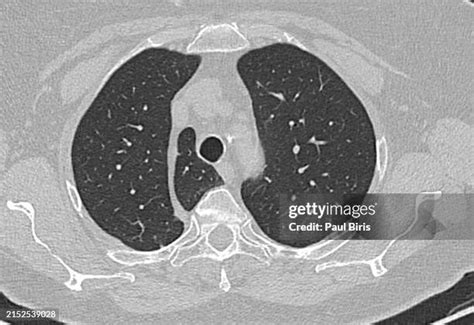 bronchiole anatomy stock  high res pictures  images