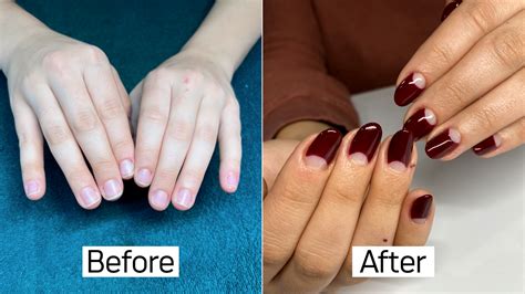 After 25 Years Of Biting My Nails I Think I’ve Finally Found A Solution — See My Before And After