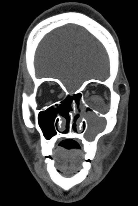 Recurrent Acute Rhinosinusitis Treatment And Management Point Of Care