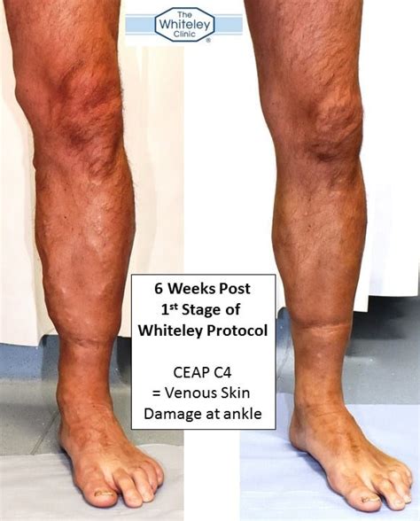 Varicose Veins And Venous Eczema Ceap C4 Whiteley Protocol