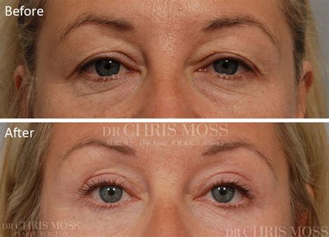 Eyelid Surgery Results Before And After Hooded Eye Surgery Chris