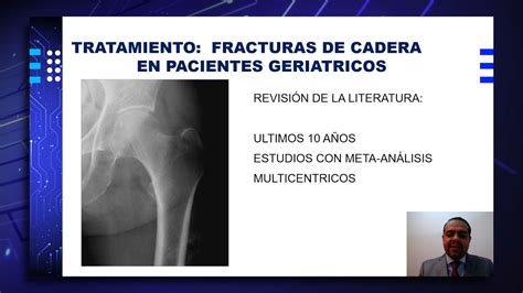 Fracturas De Fémur Proximal En El Adulto Mayor Osteosíntesis Vs