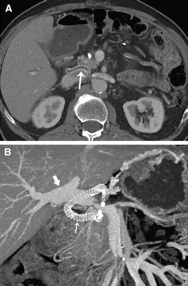 A 70-year-old man post modified Appleby procedure and jump graft from... | Download Scientific ...