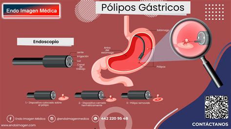 Pólipos Gástricos Endo Imagen Médica