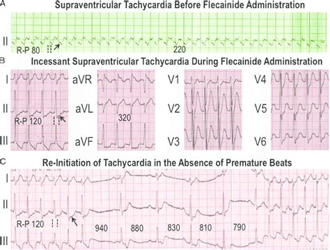 A Supraventricular Tachycardia Before Administration Of Flecainide Download Scientific Diagram