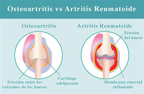 Qué diferencia hay entre osteoartritis y artritis reumatoide Que