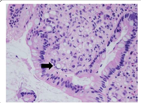 Hematoxylin And Eosin He Staining He Staining Of The Biopsy Samples Download Scientific