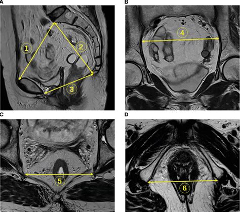 Figure 2 from An MRI-based pelvimetry nomogram for predicting surgical difficulty of ...