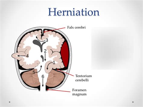 Neuroanatomy Herniation Diagram Quizlet