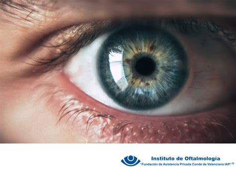 Cirug A De Glaucoma En M Xico Tratamiento Para Retinopat A Diab Tica