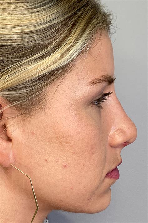 Los Angeles Rhinoplasty Before After Photos Patient 17 Dr Aminpour