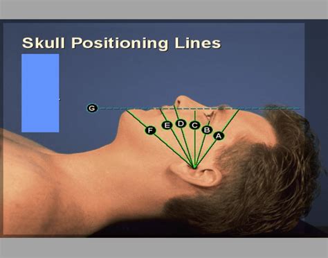 Skull Positioning Lines 2 Diagram Quizlet