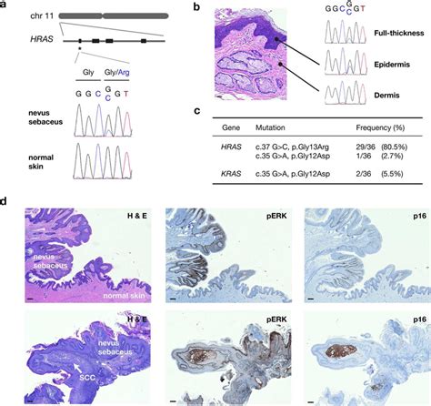 Activating Mosaic Ras Mutations In Nevus Sebaceus A Genomic