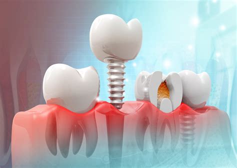 Una Breve Historia De La Implantolog A Dentista Las Arenas