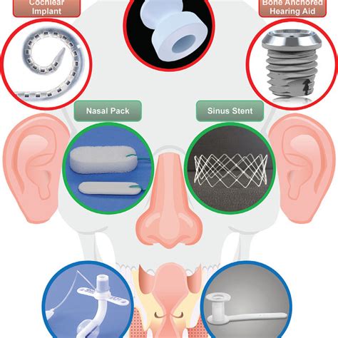 Common Surgical Implants Used In Otorhinolaryngology Ear Implants Are