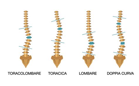 La Scoliosi Idiopatica Matteo Pennisi
