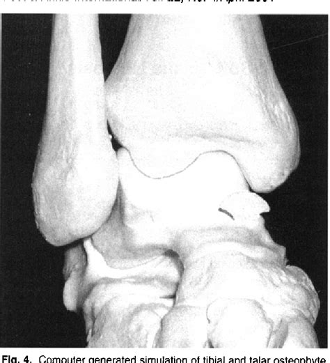 Figure 1 From Morphology Of Tibiotalar Osteophytes In Anterior Ankle