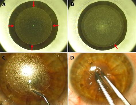 Escrs Laser Vision Correction Surgery