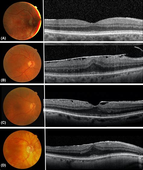 Epiretinal Membrane Oct