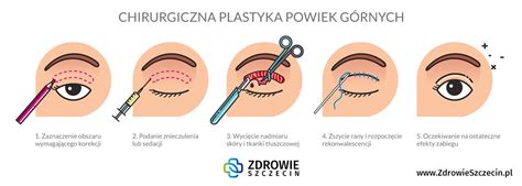 Korekcja Powiek Zdrowie Szczecin