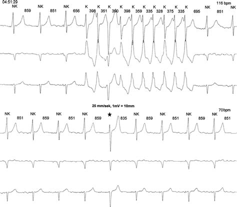 Ecg Tracing From 24 Hour Holter Monitoring Upper Panel His Bundle Download Scientific Diagram