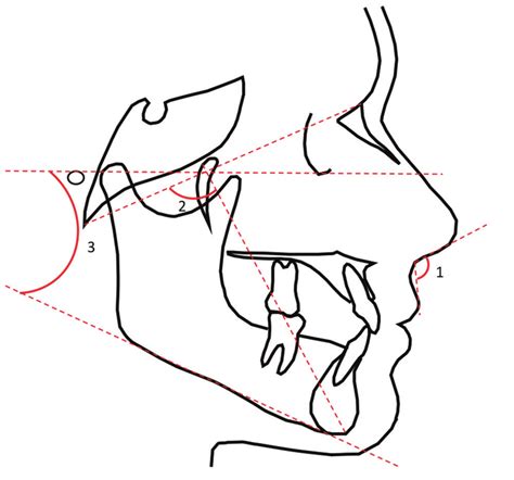 Angular Measurements 1 Nasolabial Angle Prn Sn Ls 2 Facial Axis Download Scientific