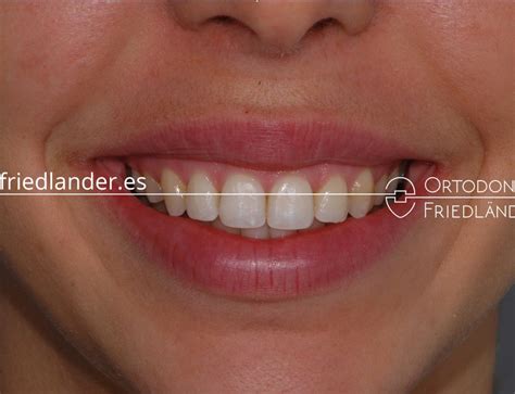 Tratamiento Con Extracciones Asim Tricas Mordida Abierta Api Amiento