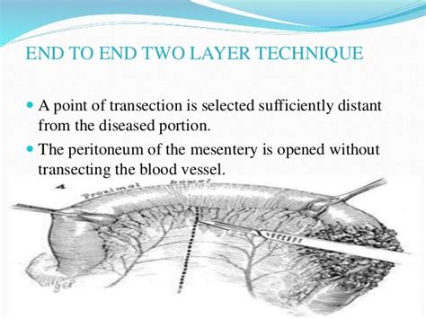 Bowel Resection And Anastomosis