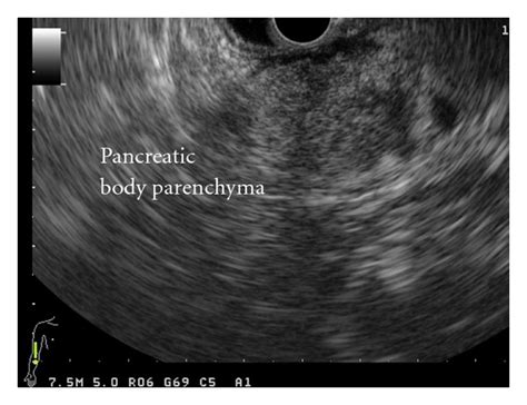 Linear Eus Showing A Markedly Inhomogeneous Pancreatic Body Parenchyma Download Scientific