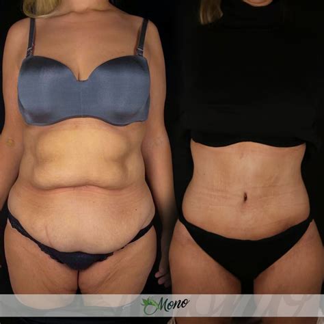 Tummy Tuck Turkey Cost Best Abdominoplasty Surgeons Reviews