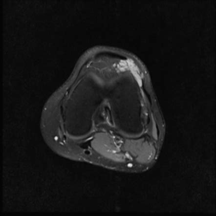 Infrapatellar Fat Pad Hemangioma Image Radiopaedia Org