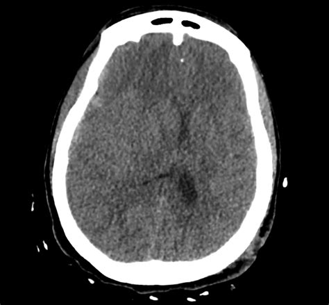 A Systematic Approach to the Interpretation of CT Head