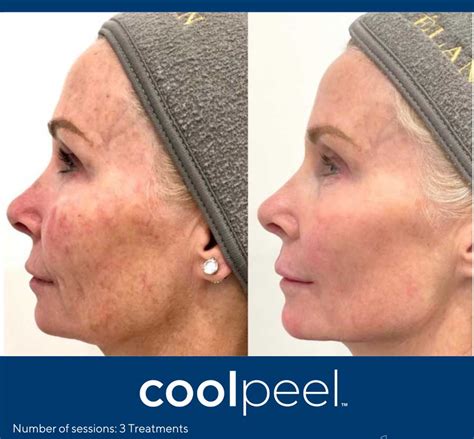 Tetra Co2 Coolpeel™ Laser Skin Science Aesthetics Tallahassee Skin Care